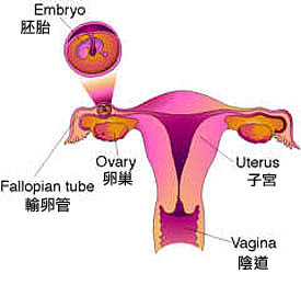 子宮外孕 Ectopic